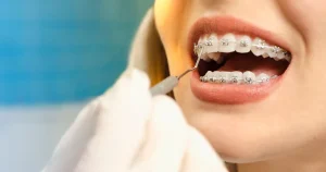 What to Expect at Smiles Orthodontics Open House Events