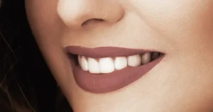Choose Teeth Whitening Vancouver BC