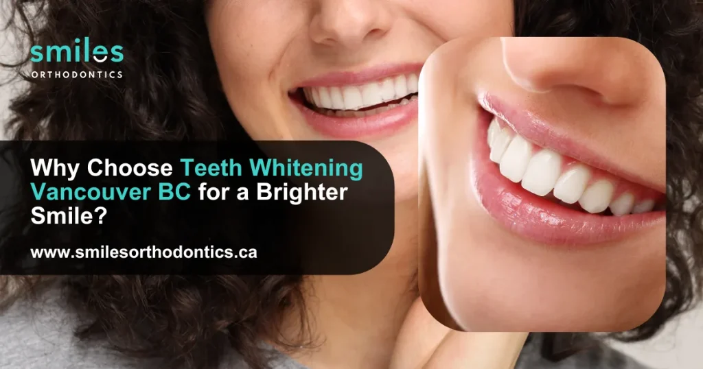 why choose teeth whitening vancouver bc for a brighter smile