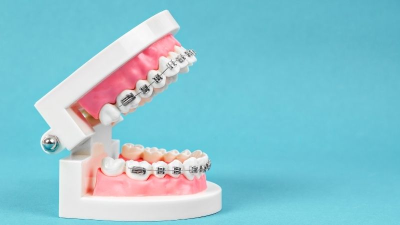 lingual braces