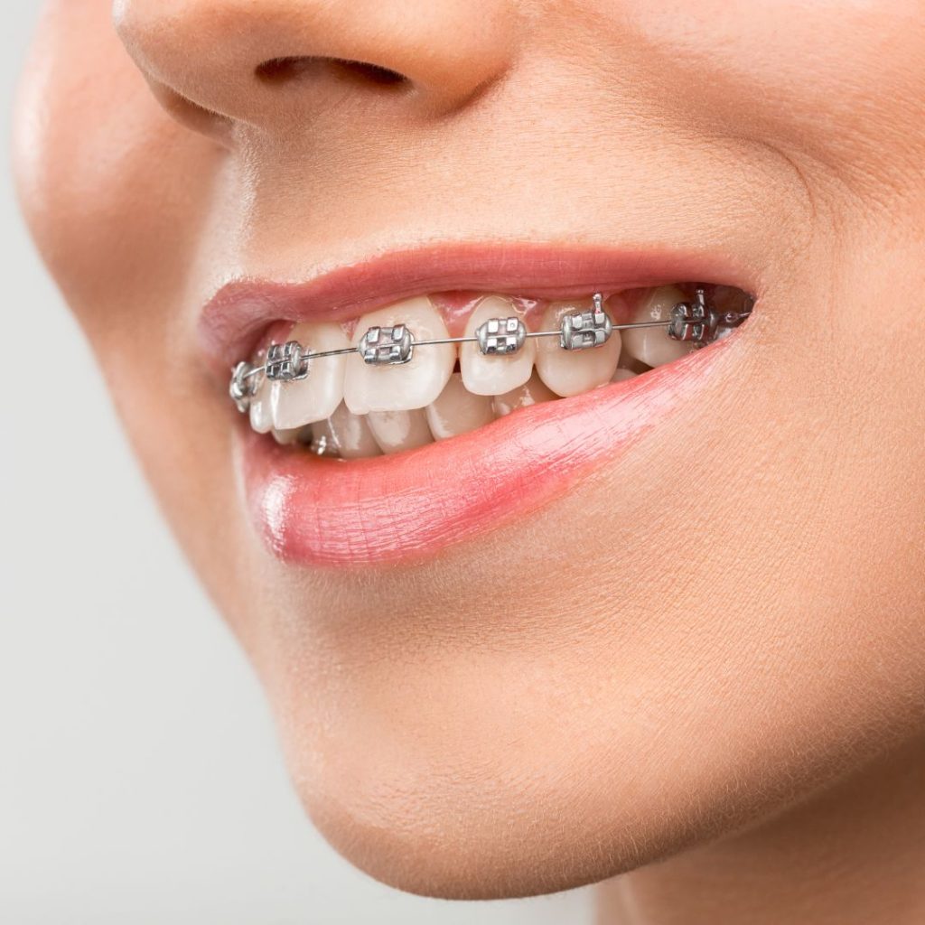 lingual braces