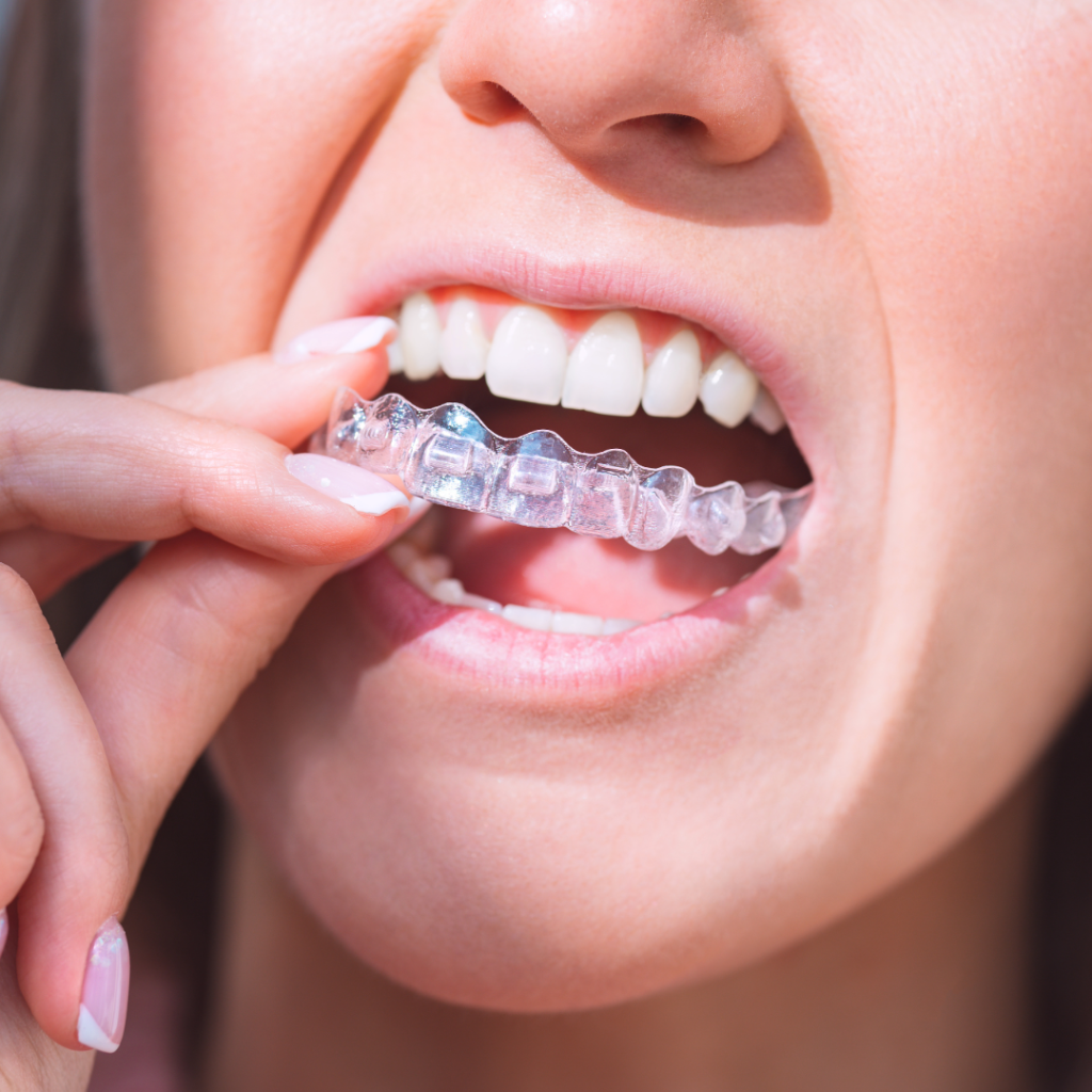 invisalign for adults