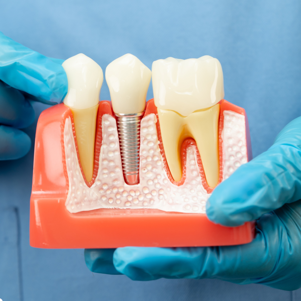 affordable dental implants