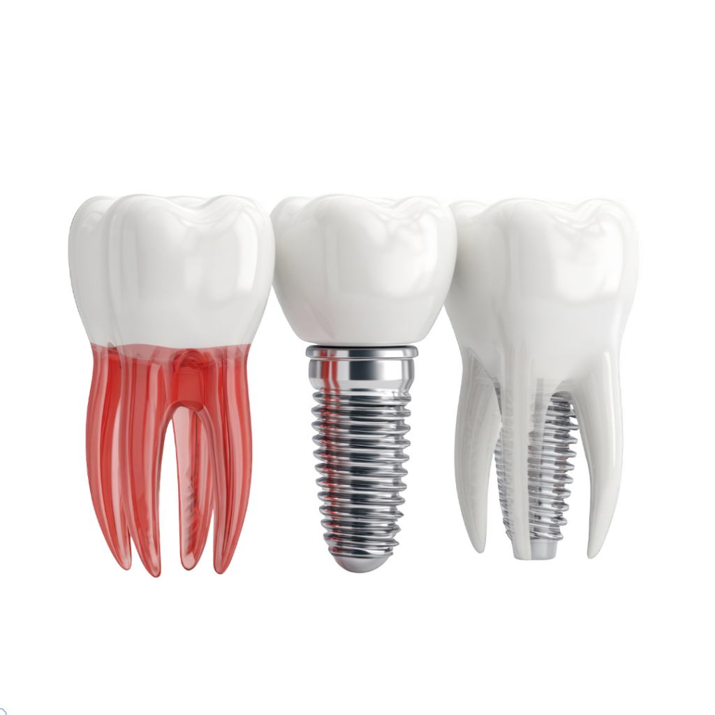 dental implants