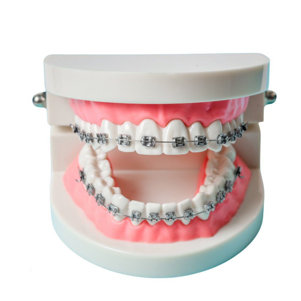 dental braces cost