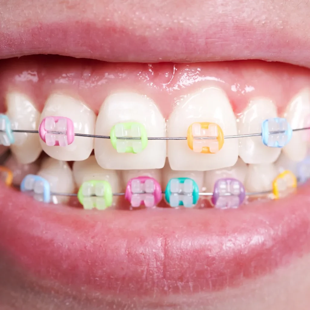 color braces for teeth