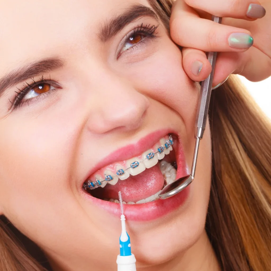 color braces for teeth