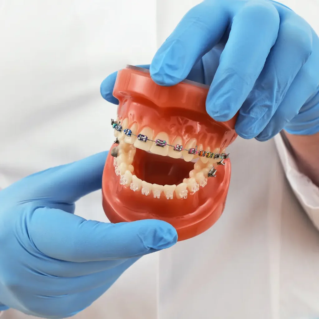 color braces for teeth (1)